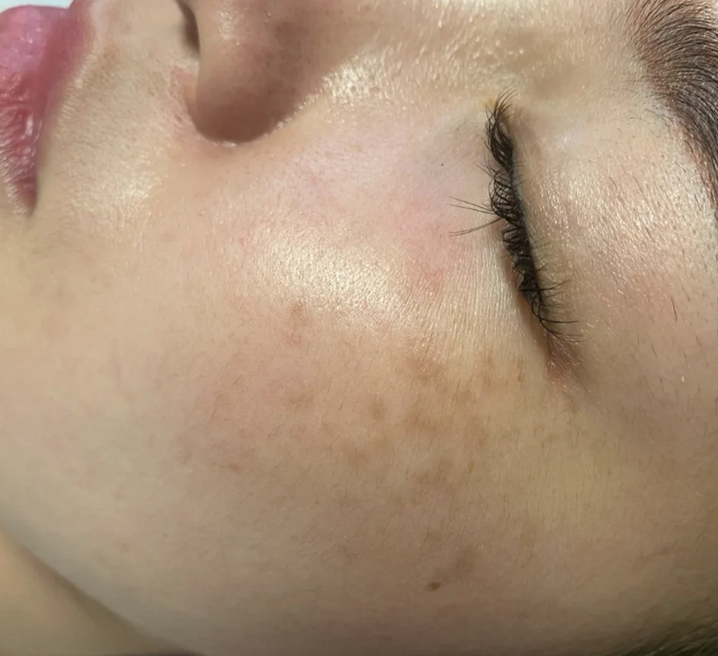 真皮斑怎样才能彻底的去掉 #医美科普挑战赛#  真皮斑是指出现在真皮