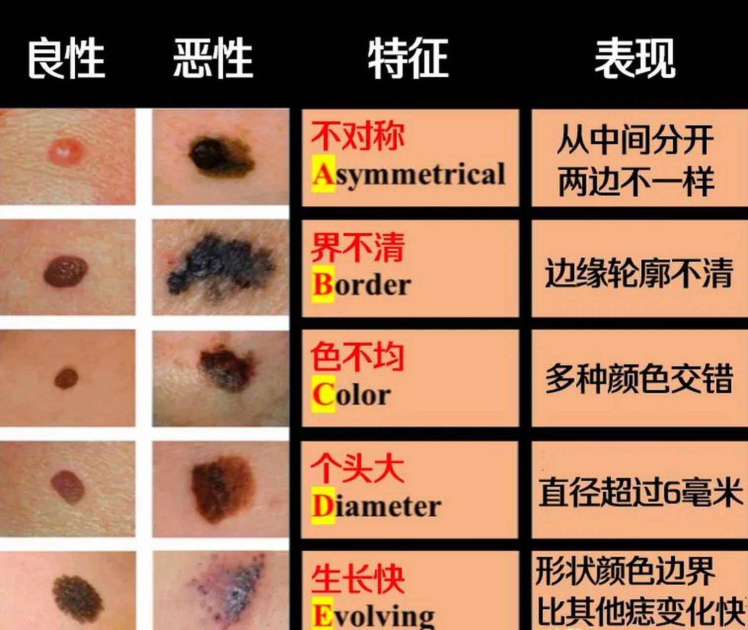 痣是良性的,可以点,而黑色素瘤是恶性的,千万不能随便点.