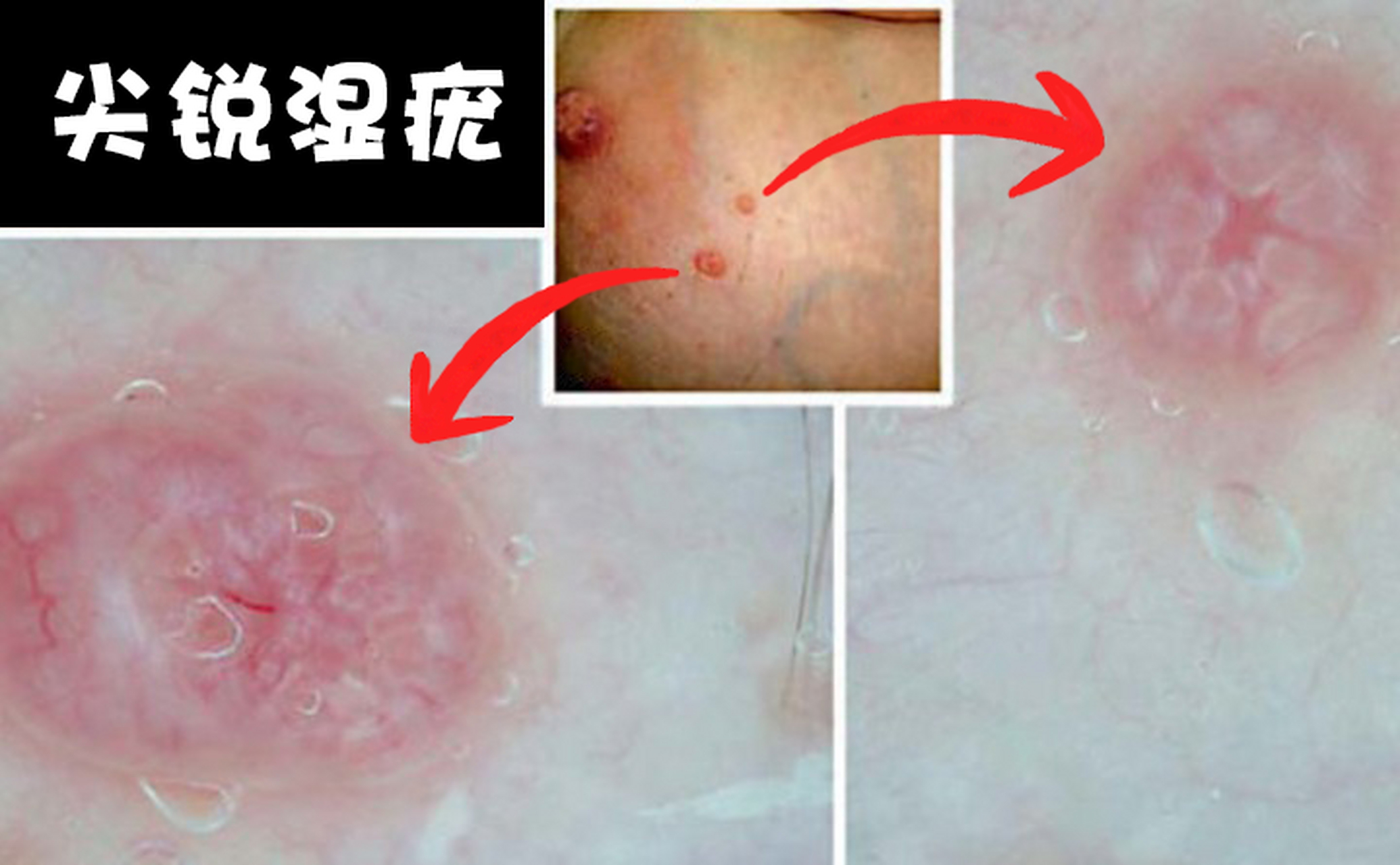 无论对于男性还是女性而言,尖锐湿疣都是一种较为常见的性病.