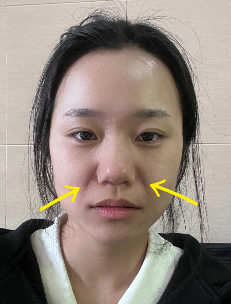 六胜肽去皱是真的吗?六胜肽是一种常见的护肤成分,据说可以有效去皱.