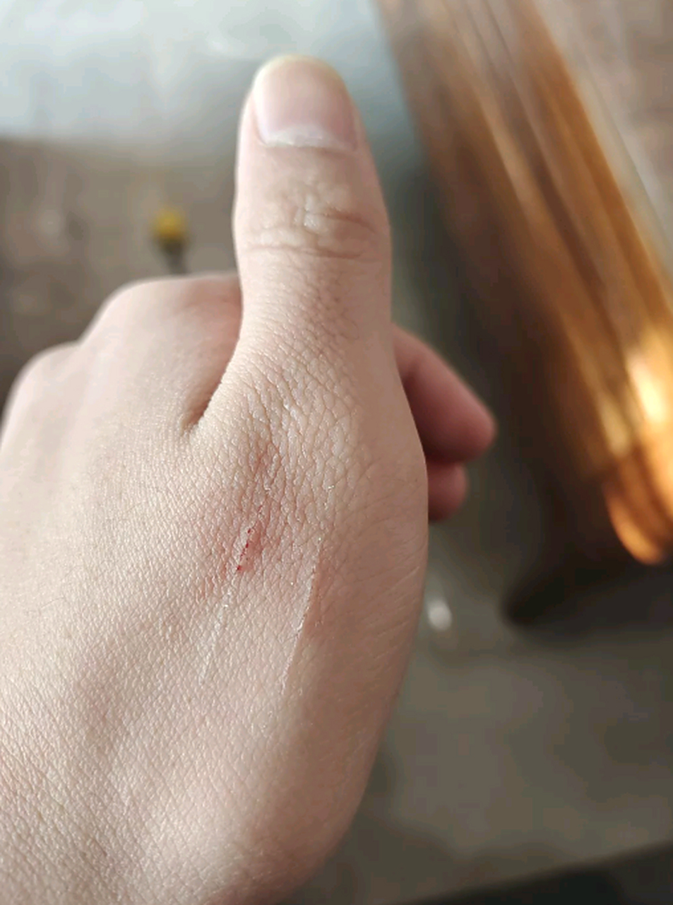 被小狗抓伤了,这需要去打狂犬疫苗吗