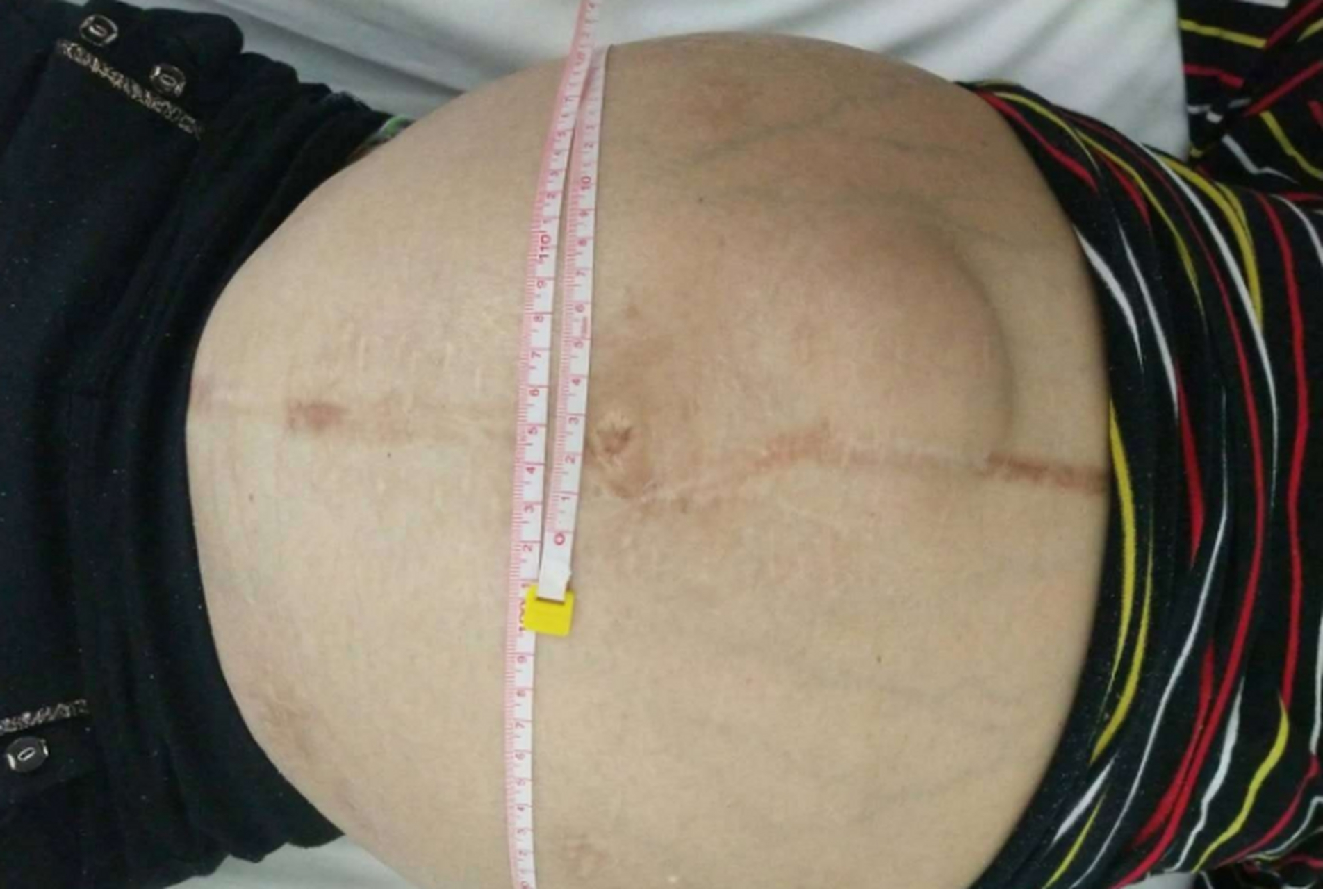 肝腹水怎么把水排出来?