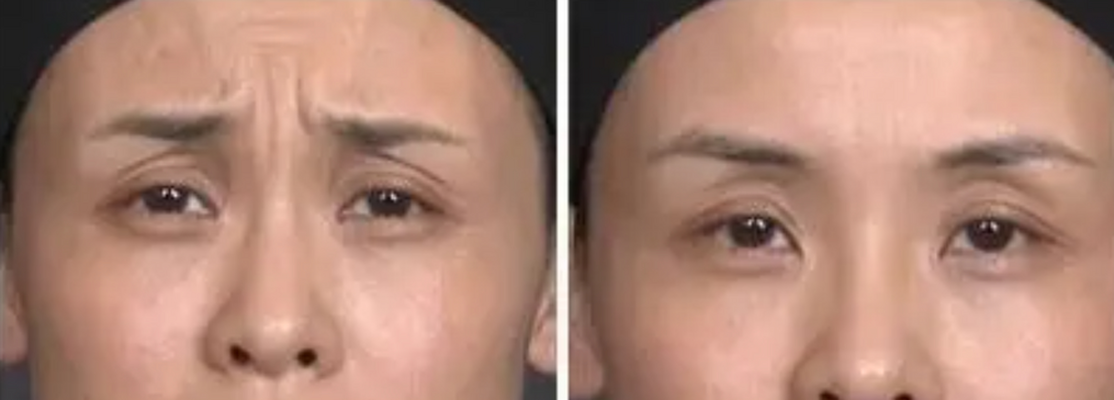 川字纹是怎么形成的?