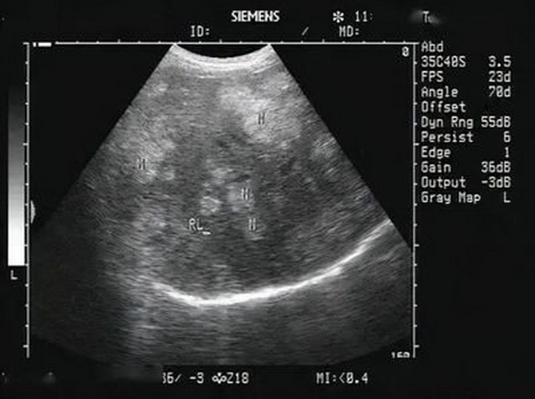 肝硬化的病人在彩超上看到低回声的结节,里边有血流信号,这时候就要