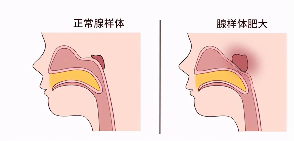 腺体扩展到鼻腔后端,阻塞后倍腺样体肥大儿童腺样体肥大示意拖儋