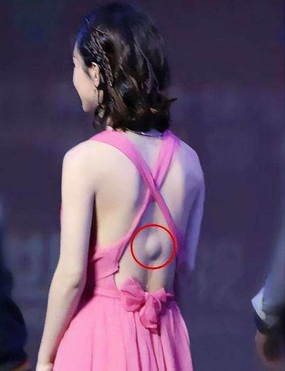 赵丽颖后背怎么有个包?是生病了吗?