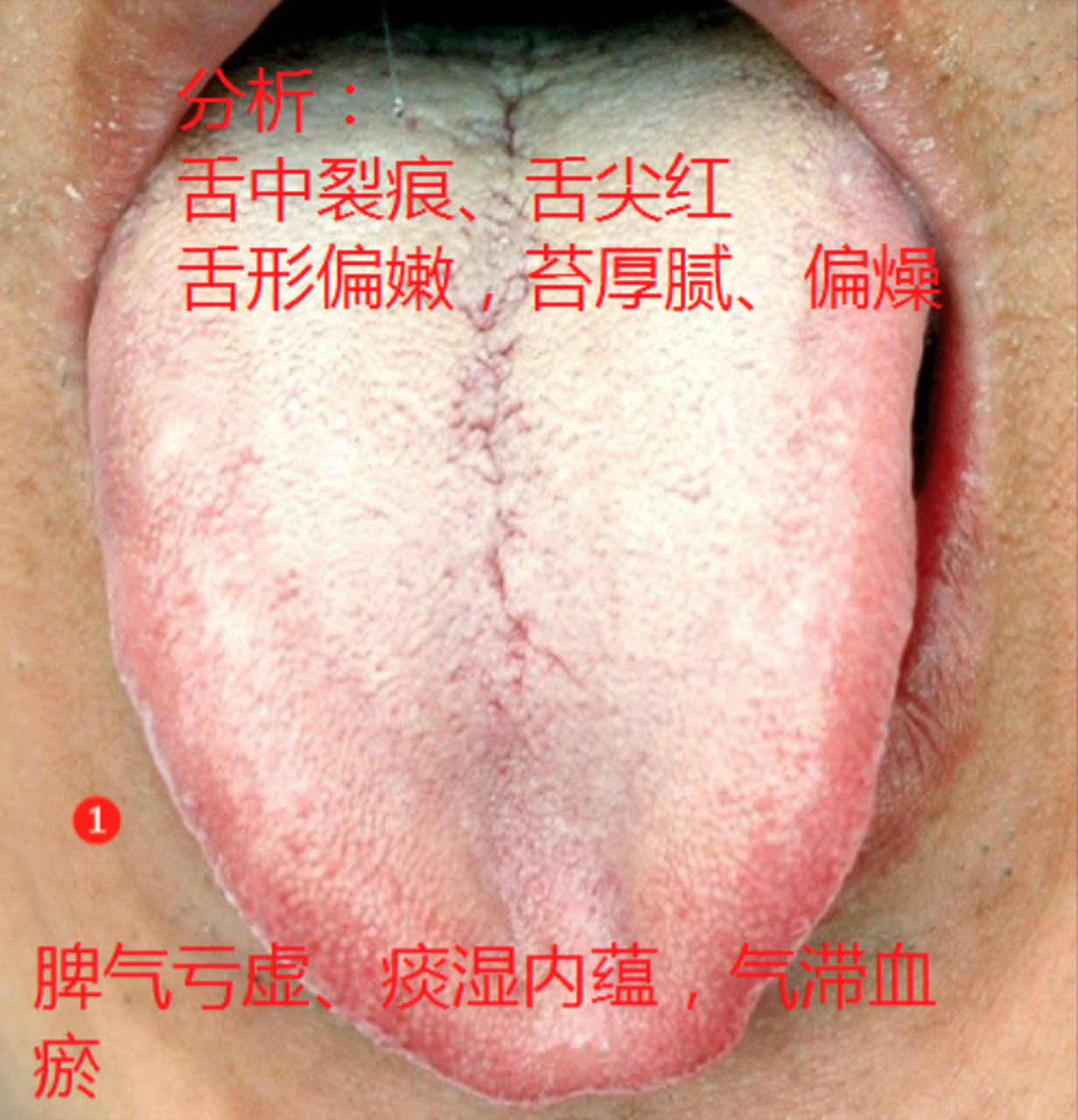 图1——多见是脾气亏虚,痰湿内蕴,气滞血瘀   图2——多见为痰湿蝗热