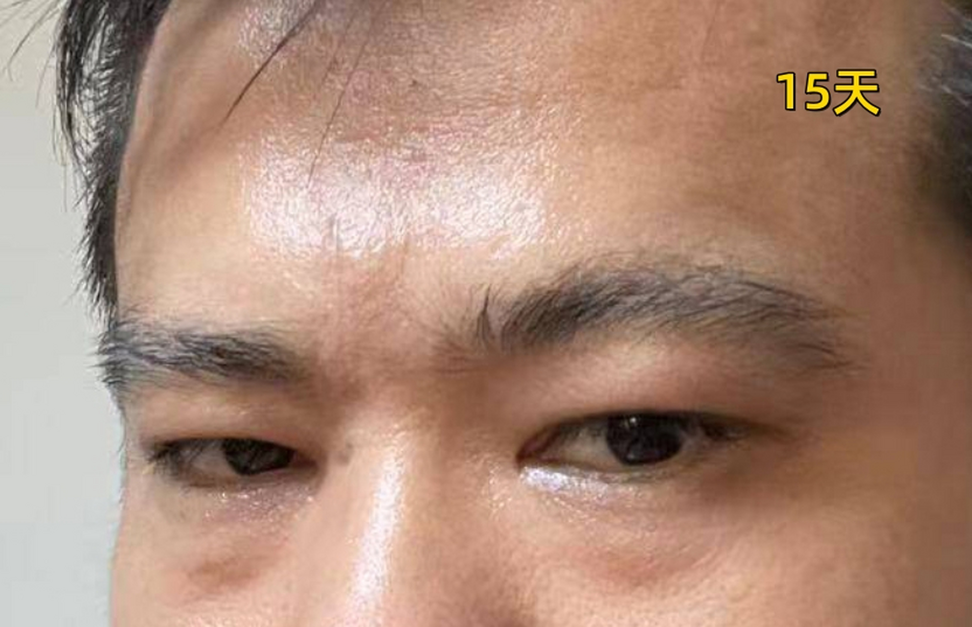 深圳小伙子36岁,川字纹已经这么深,来北京做切除才半个月眉间就平了!