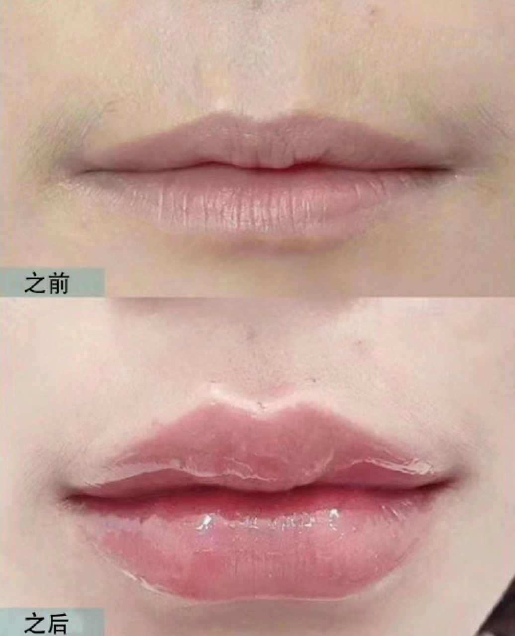 玻尿酸丰唇术后效果[庆祝] 即刻增强唇部立体感,嘴巴嘟嘟惹人爱 温柔