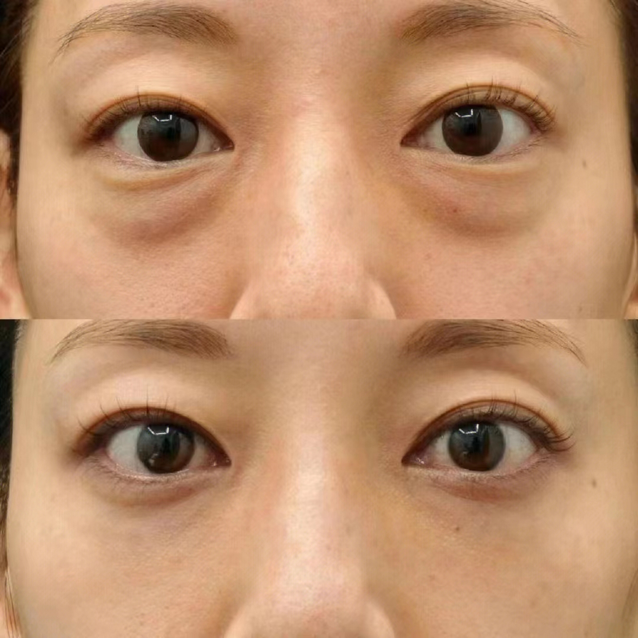 年龄感不只在轮廓线也在于眼周 眼周年轻化亦至关重要 眼袋一祛 视觉