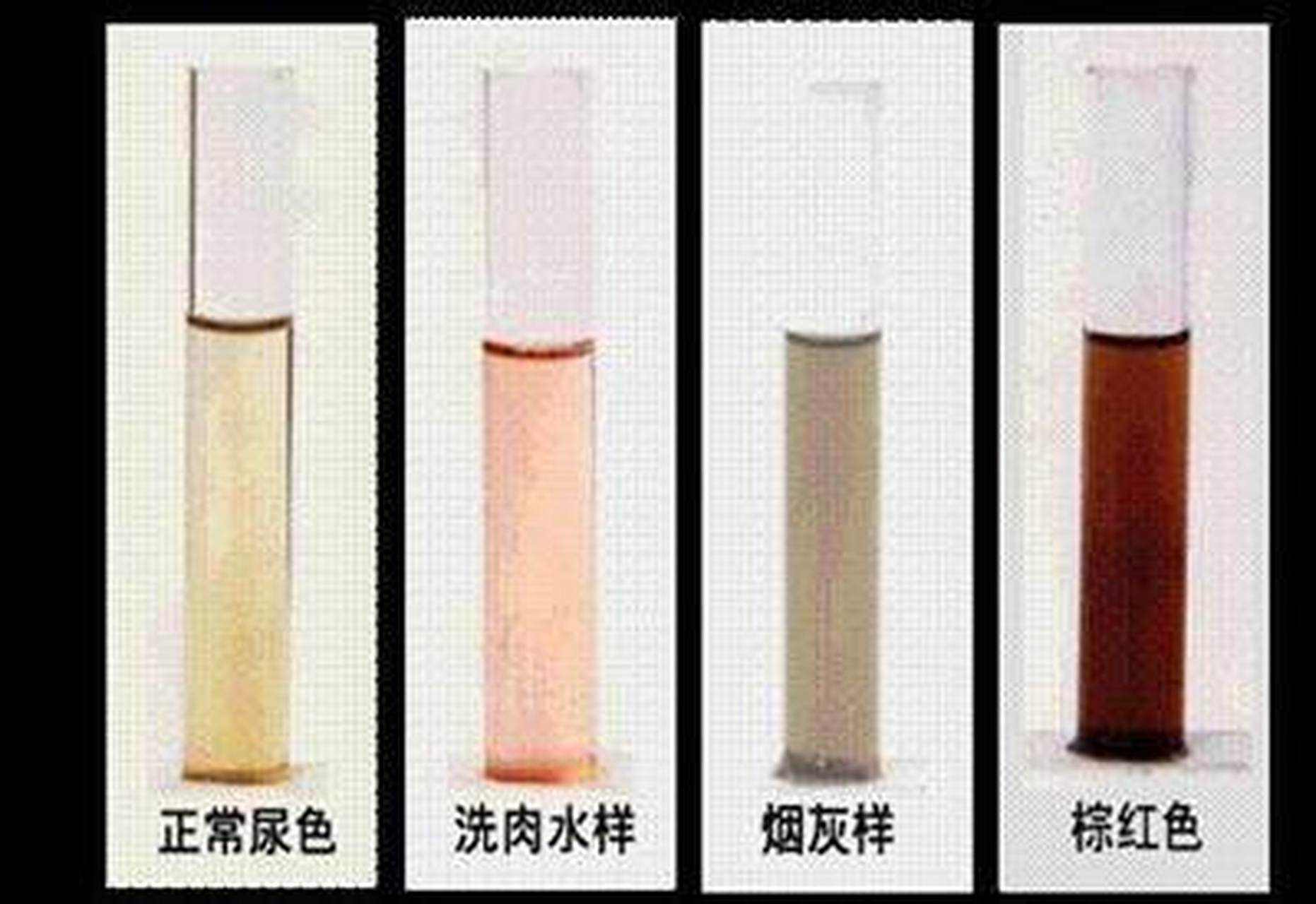 【血尿:不能延误的身体示警】  尿中带有一定红细胞的时候,就被称为