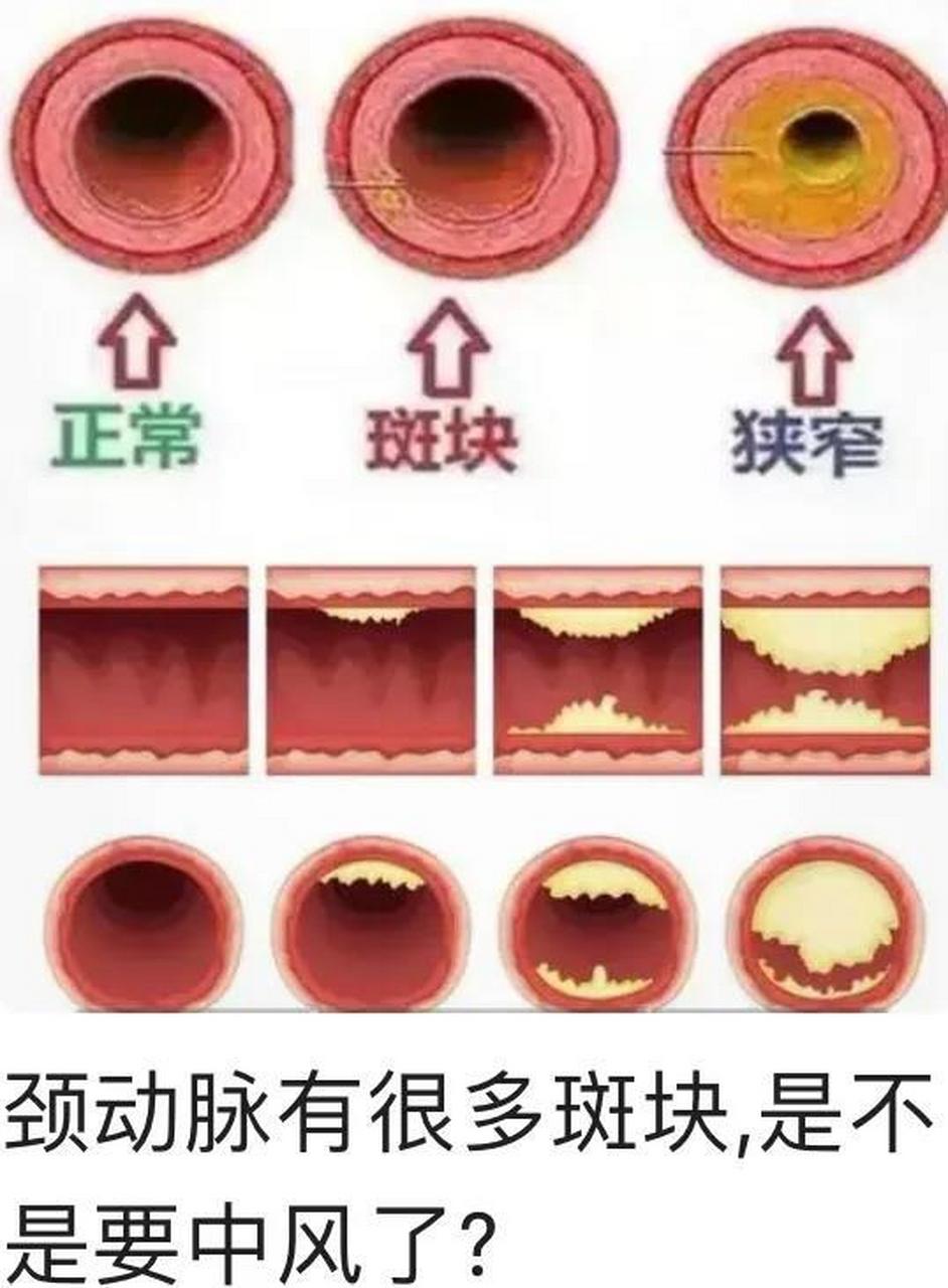 颈动脉斑块图片及说明图片