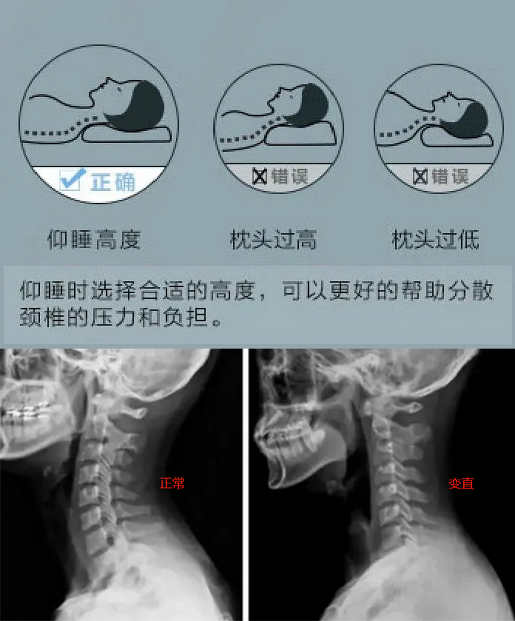 颈椎生理曲度变直主要是由于颈部肌肉过于紧张,长期保持相同的姿势