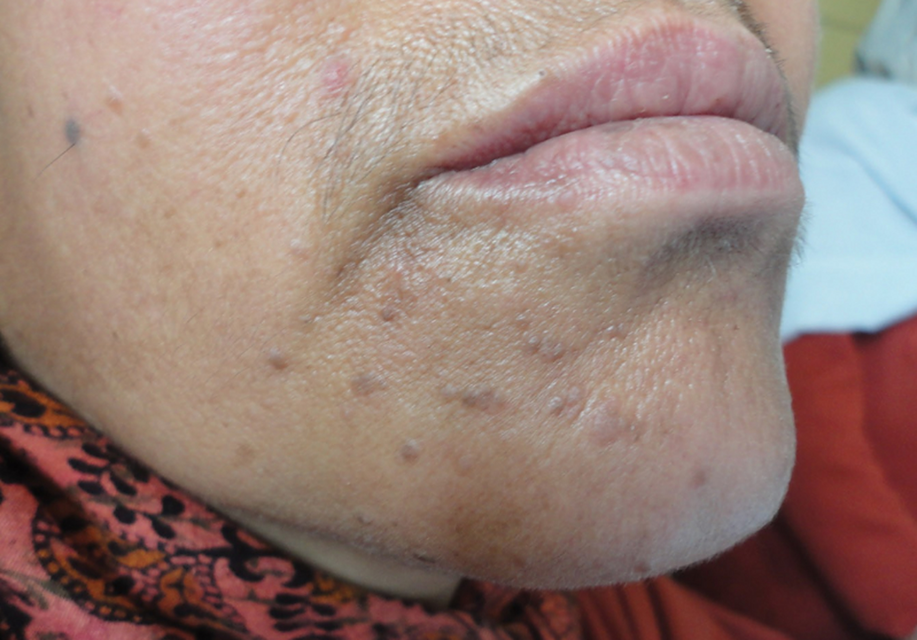 扁平疣是一种由人乳头瘤病毒(hpv)感染引起的皮肤病,它的复发与蚁下