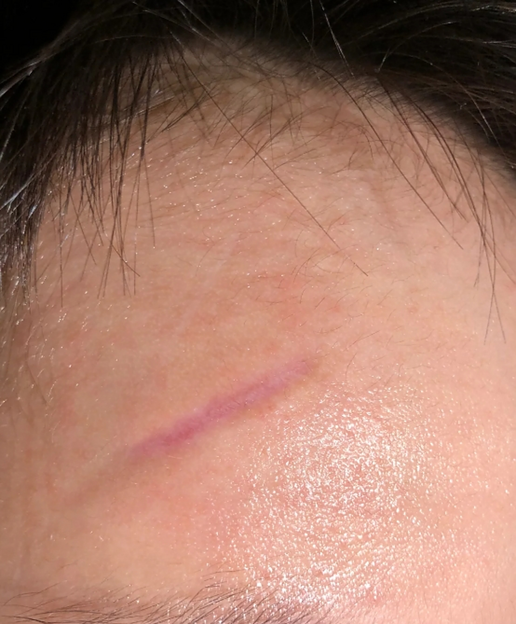 凹陷的疤痕是皮肤损伤后形成的一种不规则的凹陷性疤痕,通常是由于