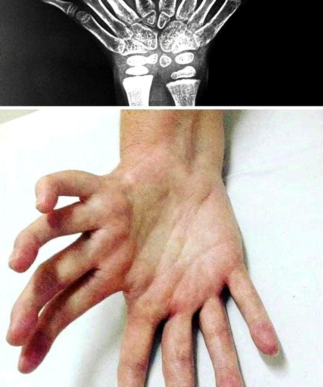 猿手畸形的图片图片