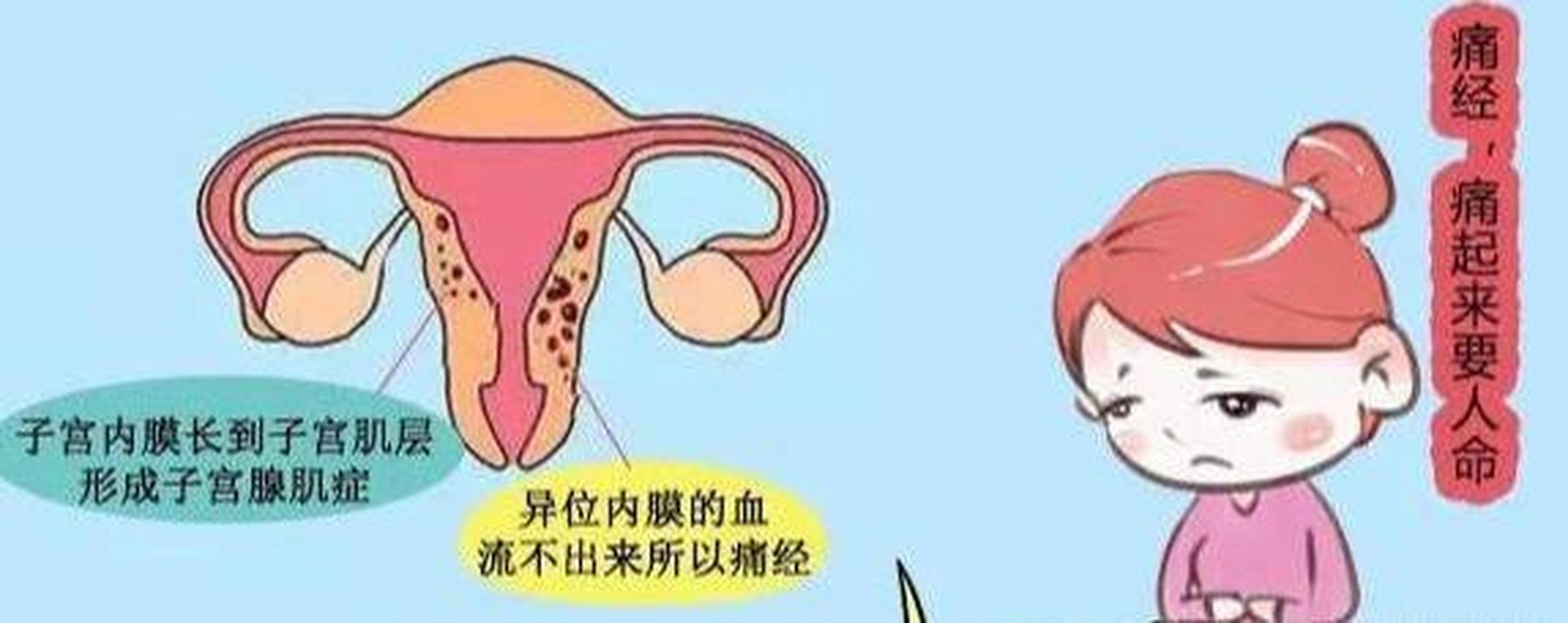 使用地诺孕素片治疗"腺肌症"警惕这些副作用  #腺肌症# #上海子宫腺肌