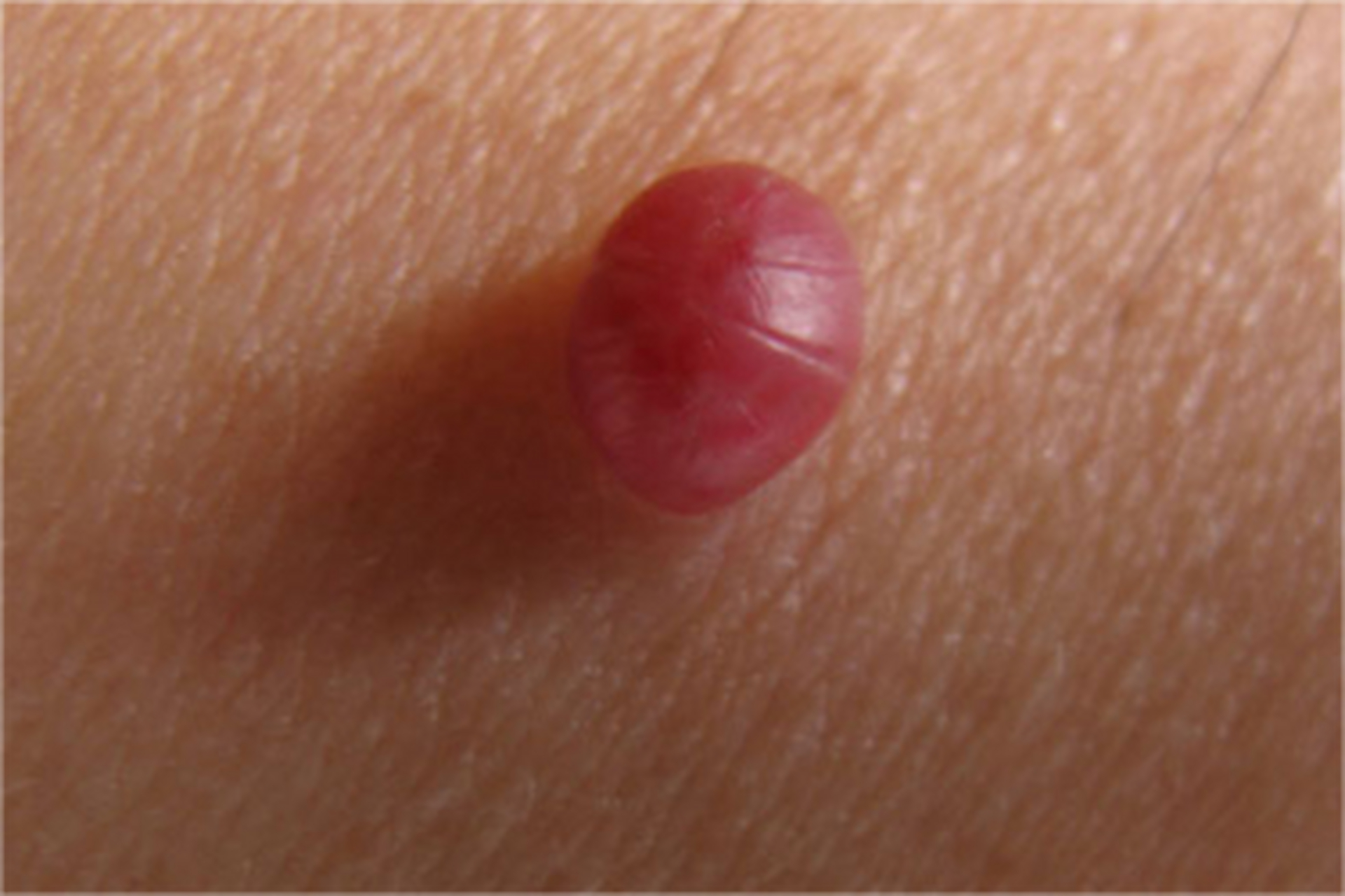 而血管瘤是血管组织的一种良性肿瘤,是瘤样增生而形成,一般是红色的