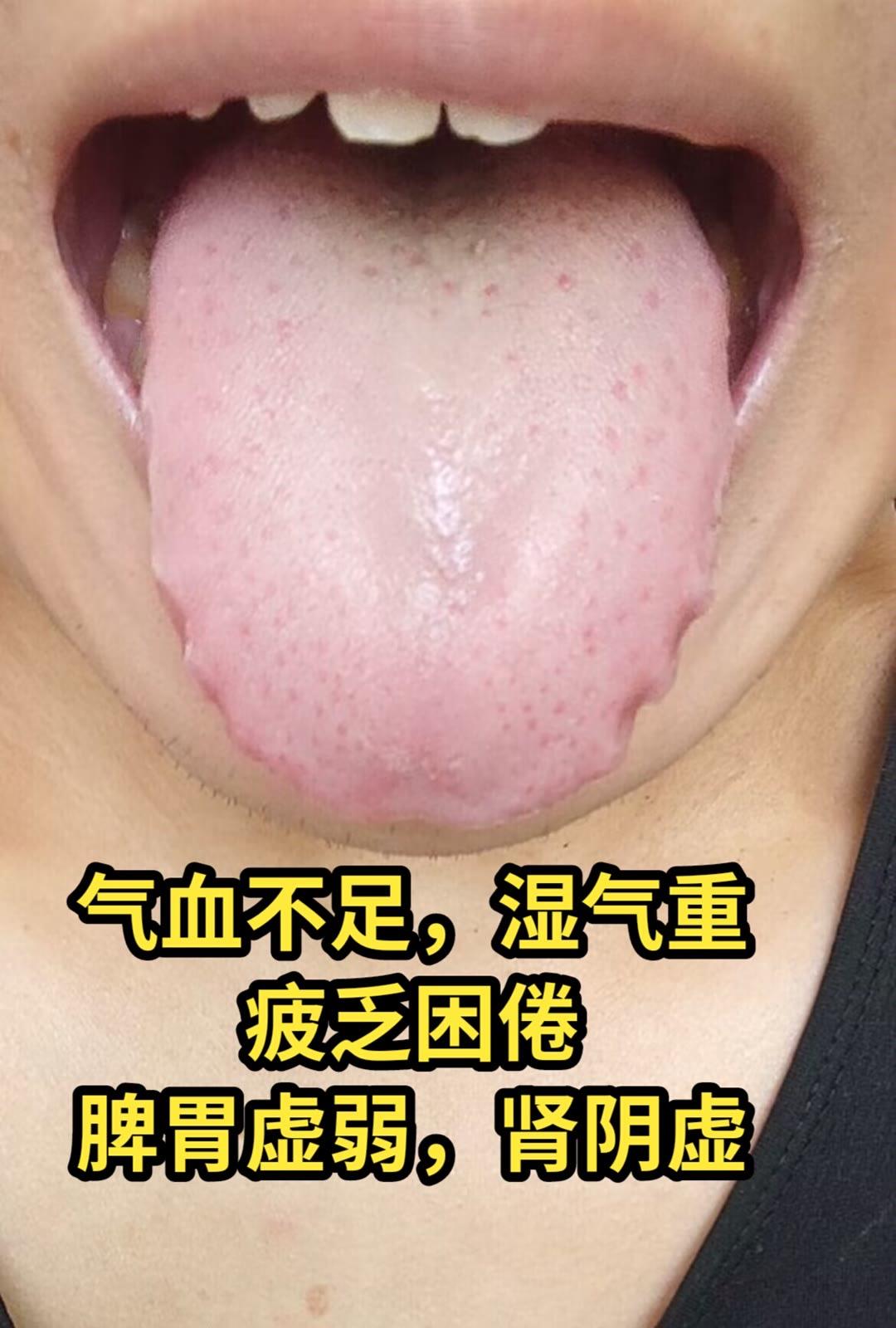 肾阴虚舌苔图