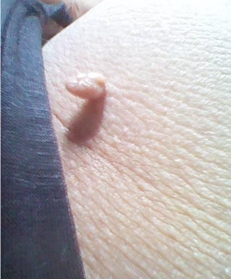 身上长小肉疙瘩图片为什么身上有小肉疙瘩小肉瘤不痛不痒的小疙瘩图片