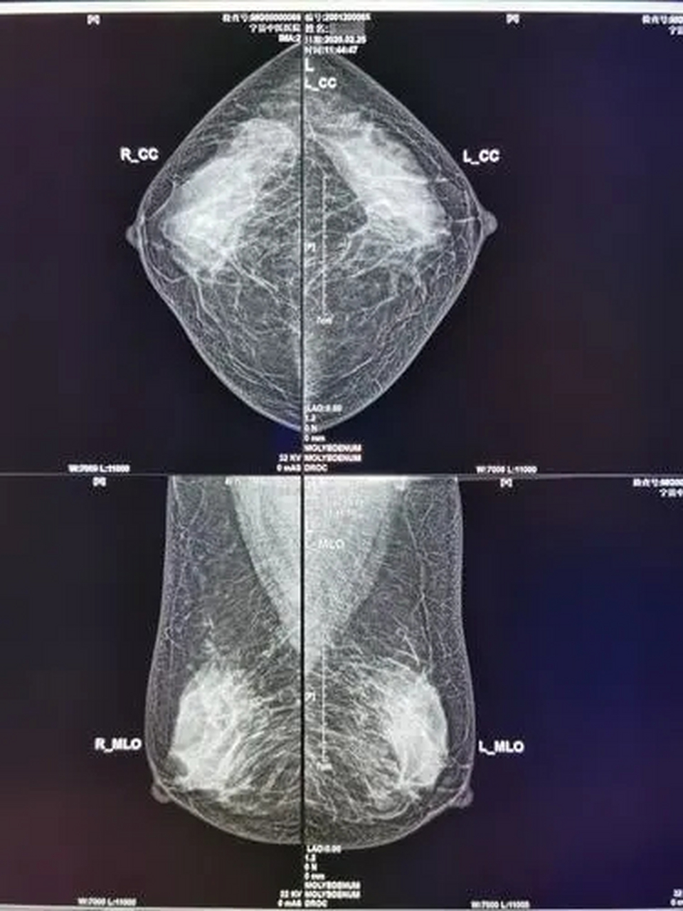 虽然国外很推崇木钯,但是钼靶对亚洲女性的致密乳腺
