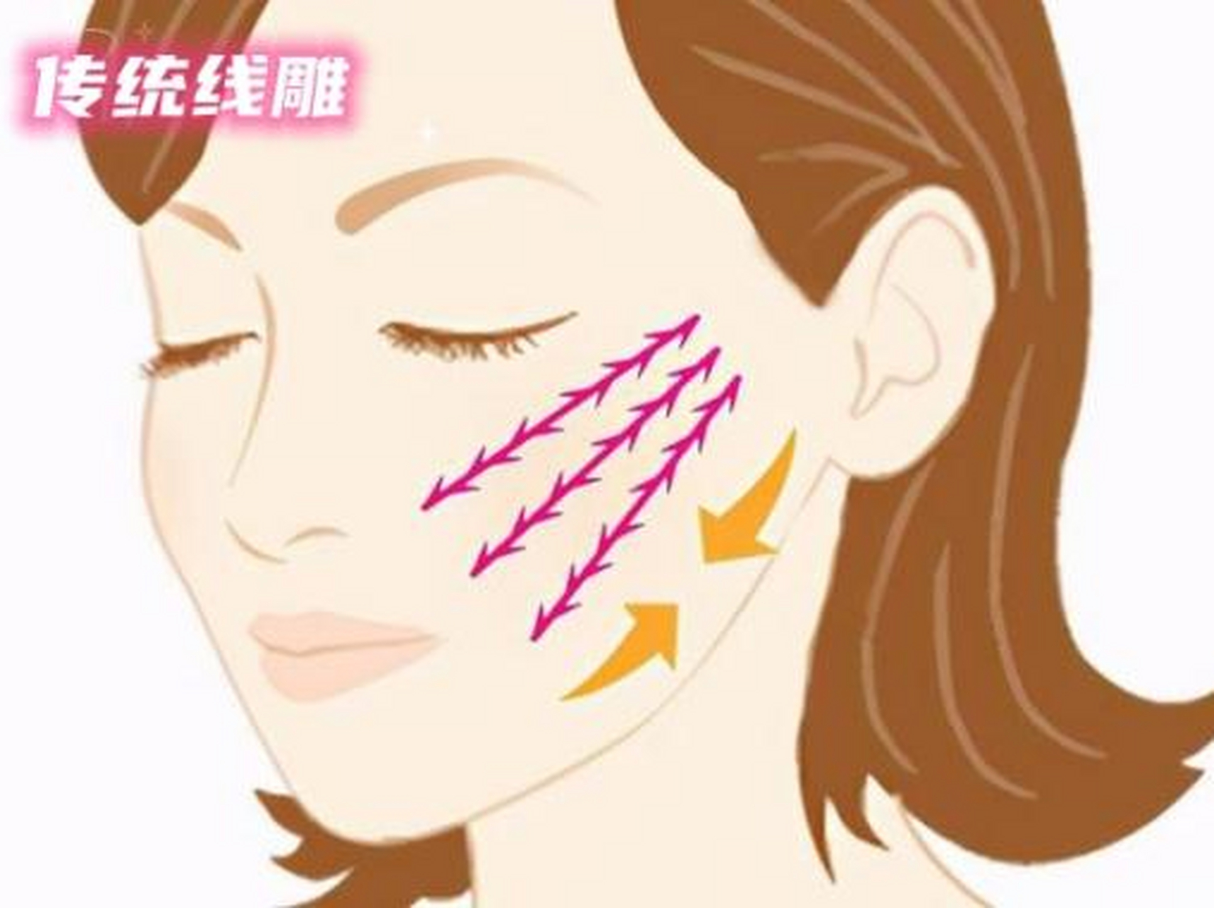 "本想靠线雕把下垂的苹果肌提起来,没想到把颧骨拉宽了,导致整张脸又