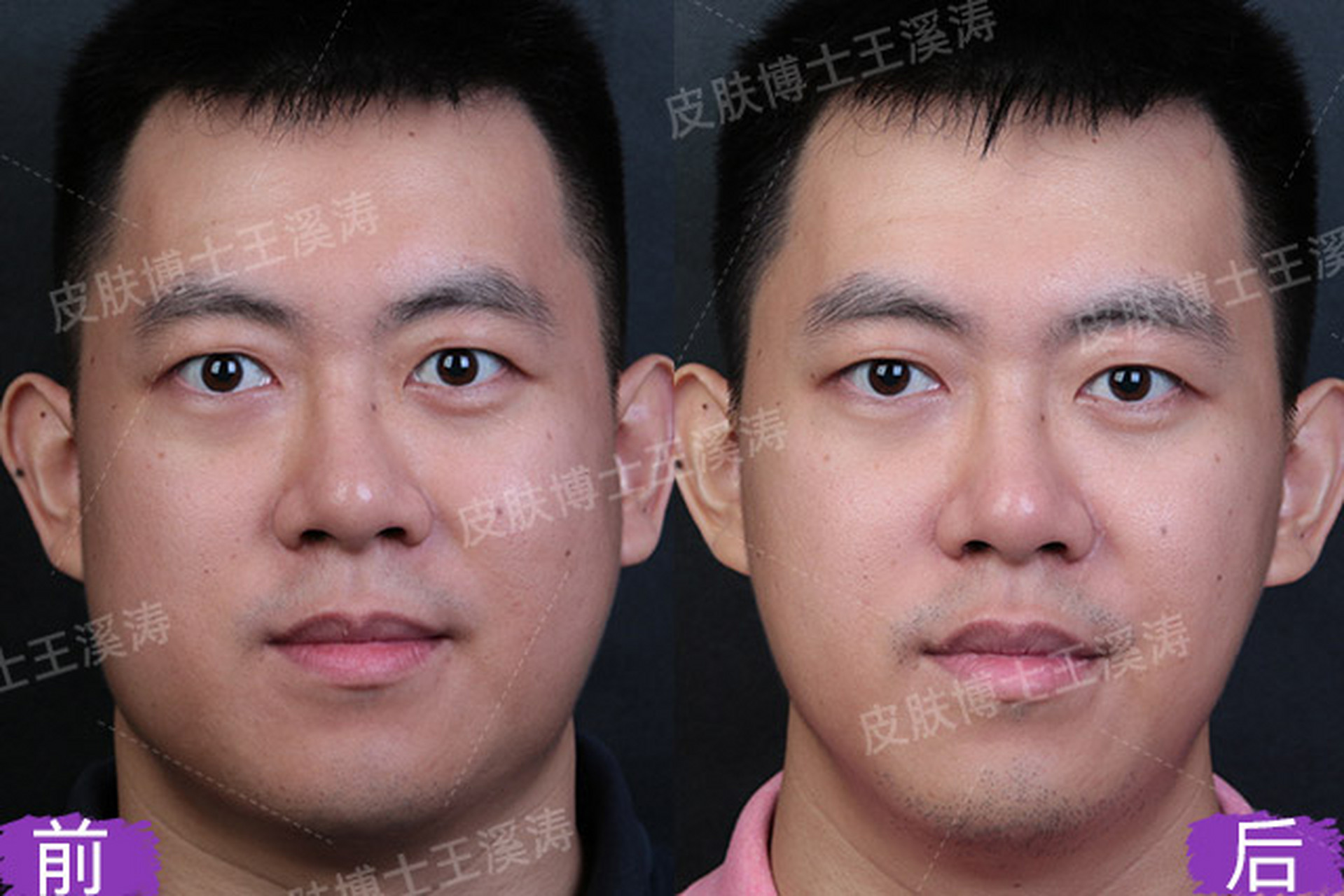 这位男士之前有双下巴,下颌缘不清晰,有赘肉,显得脸大,两腮像是发面