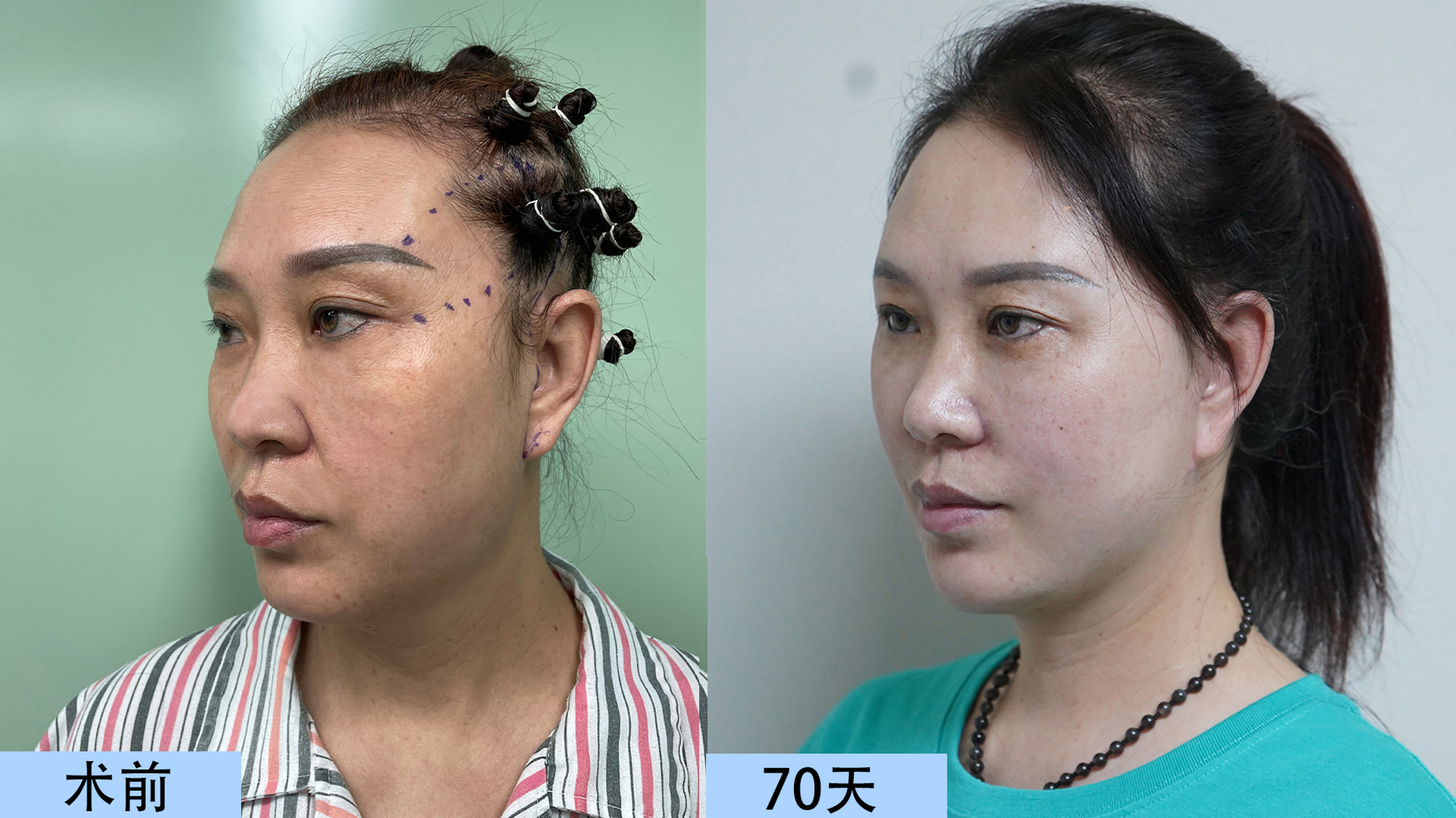 法令纹#   经过医生专业面诊,确定了大拉皮手术 重睑 筋膜瓣填充