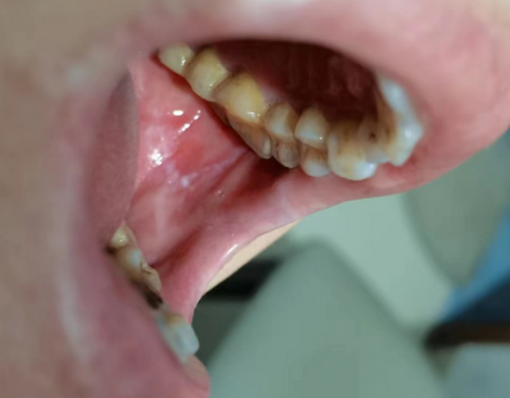 很多人都不了解口腔黏膜科这个科室,一般口腔里有什么不舒服就去看