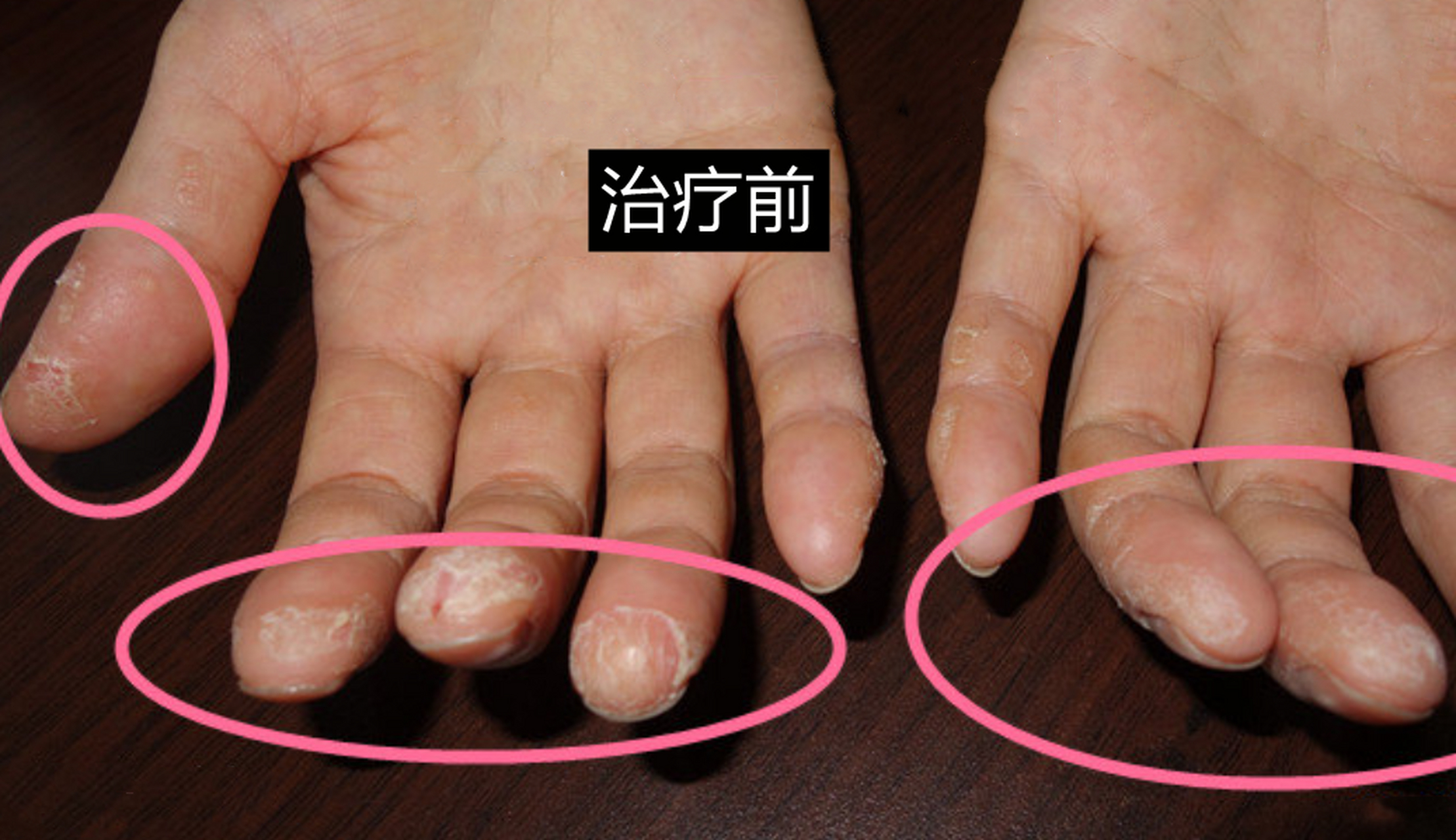 这位患者手湿疹反复多年,双手指经常瘙痒,脱皮,裂口子,这些年前夯换