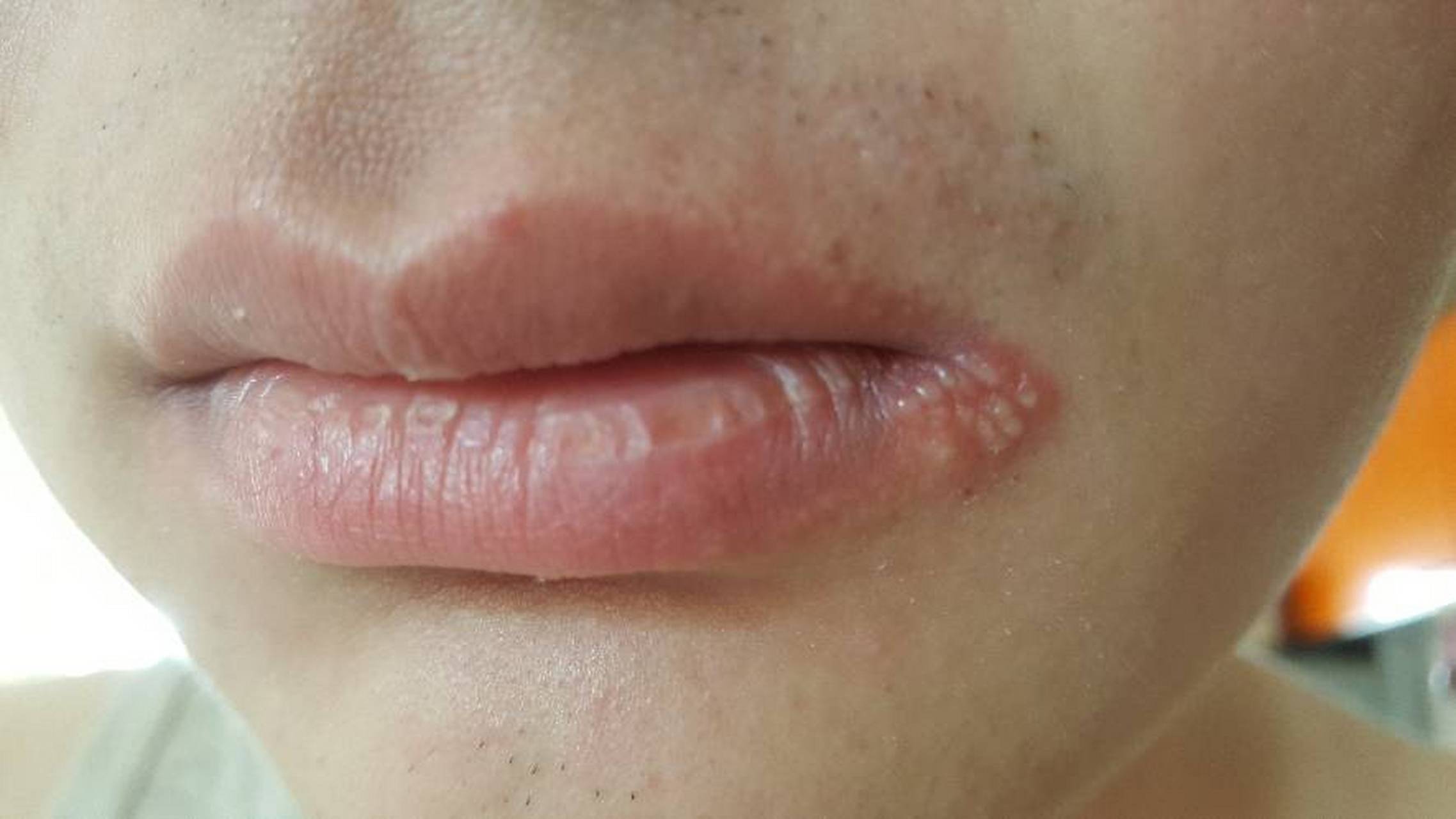 嘴角起泡是因为上火吗?