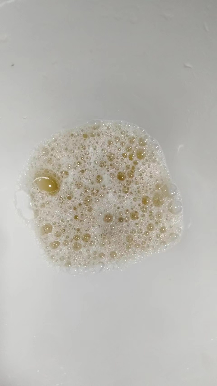 尿液出现泡沫就是蛋白尿?