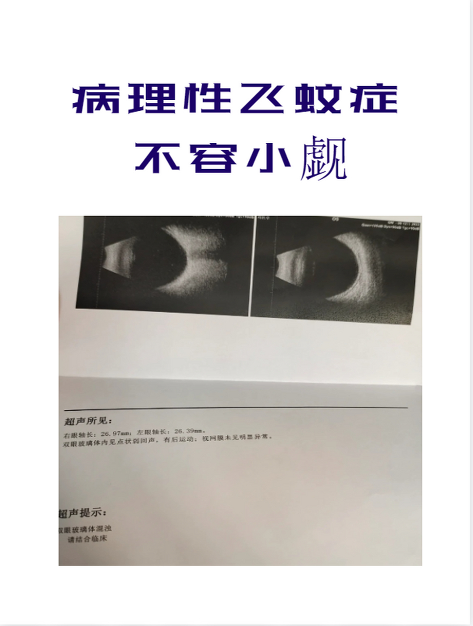 什么是病理性飞蚊症? 病理性飞蚊症指的是由于其他眼病导致的飞蚊症.