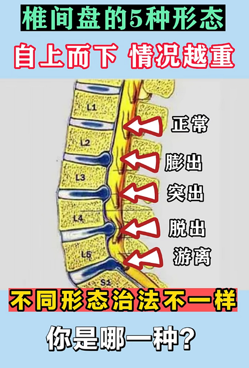 椎间盘的5种形态 自上而下 情况越重  l1:正常 l2:膨出 l3:突出 l4