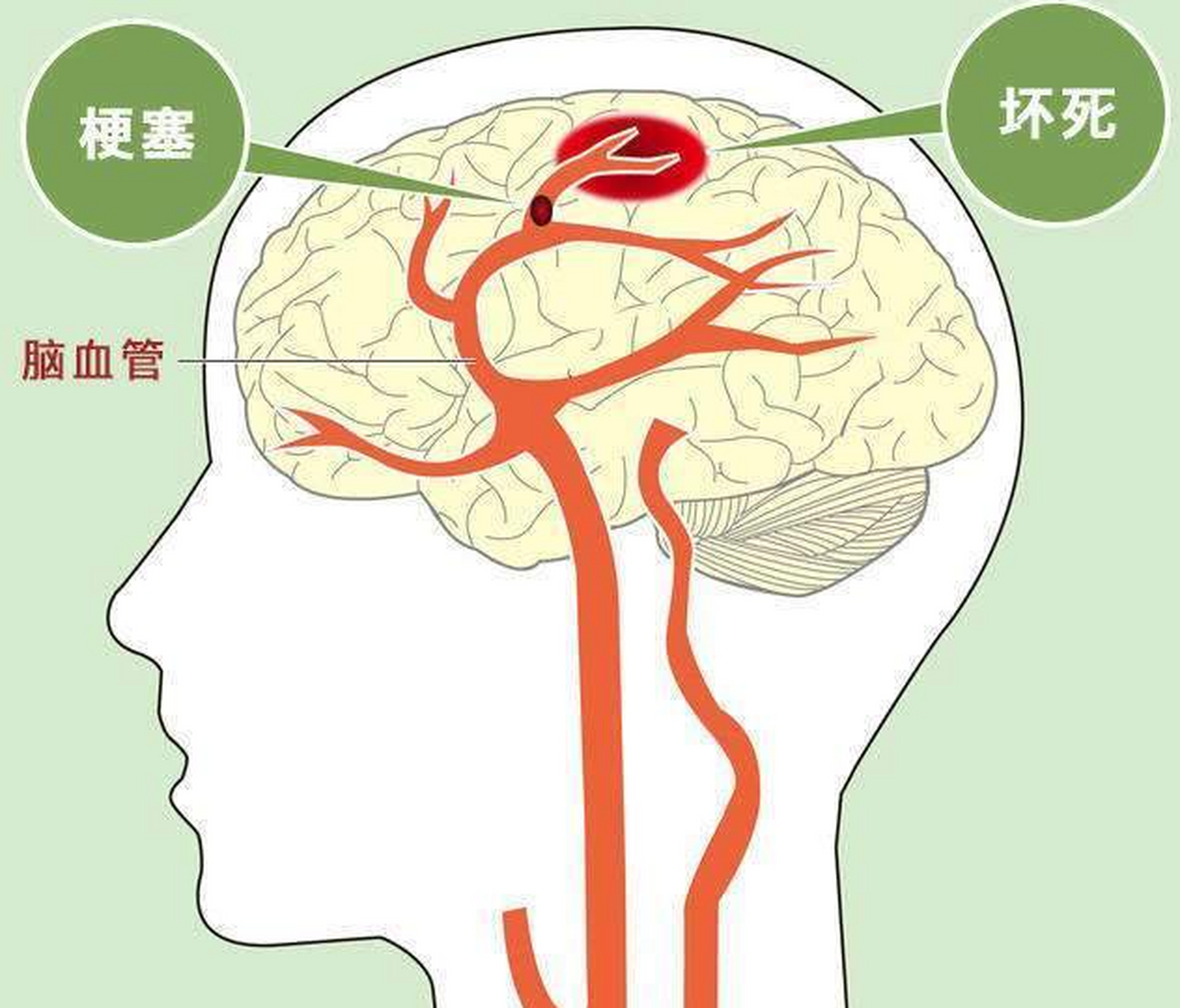 视力损伤  5.吞咽困难  6.小脑共济失调  7.导致癫痫出现