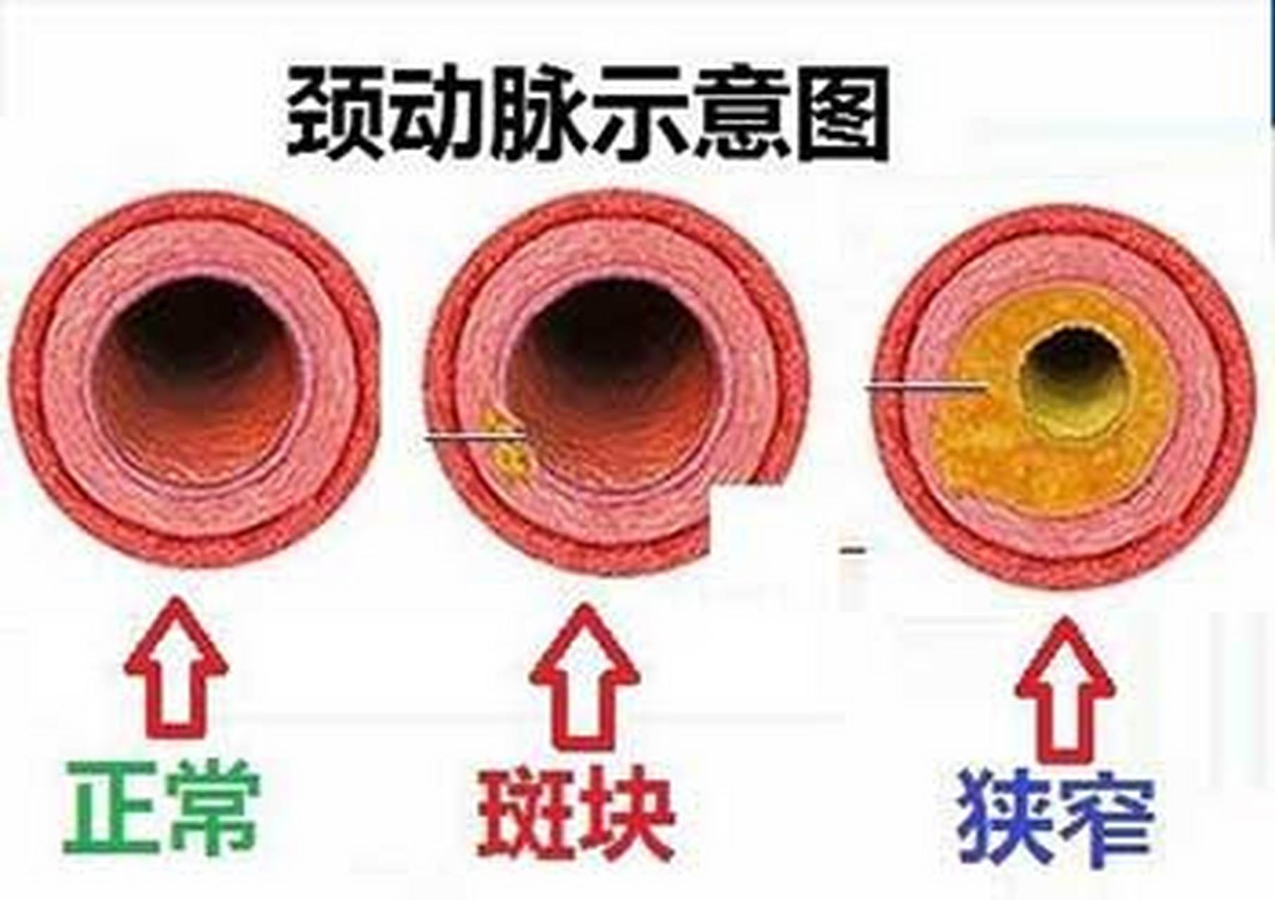 颈动脉斑块图片及说明图片