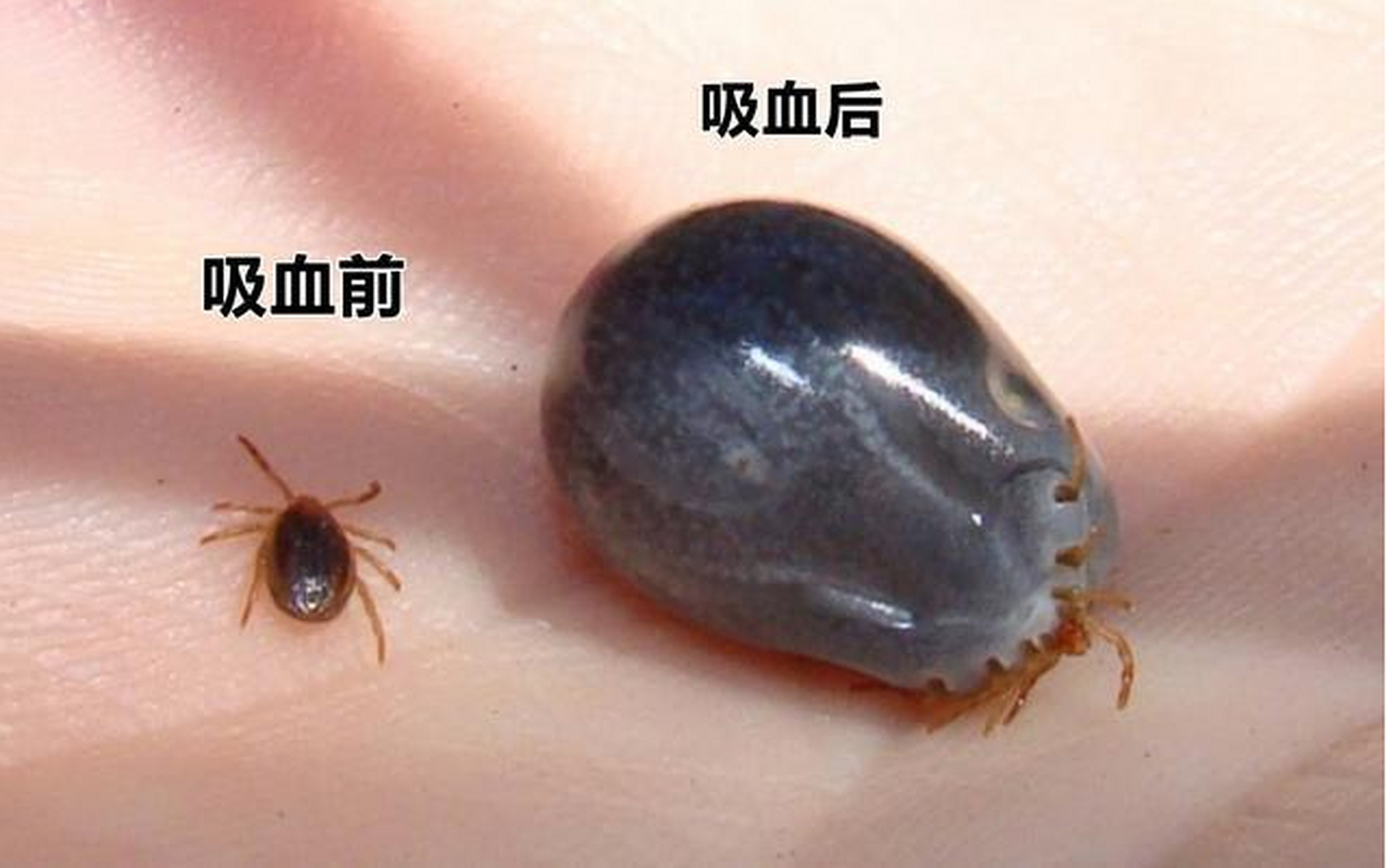 一般被蜱虫叮咬后可引起局部过敏,破溃,发炎等症状,大多较轻微.