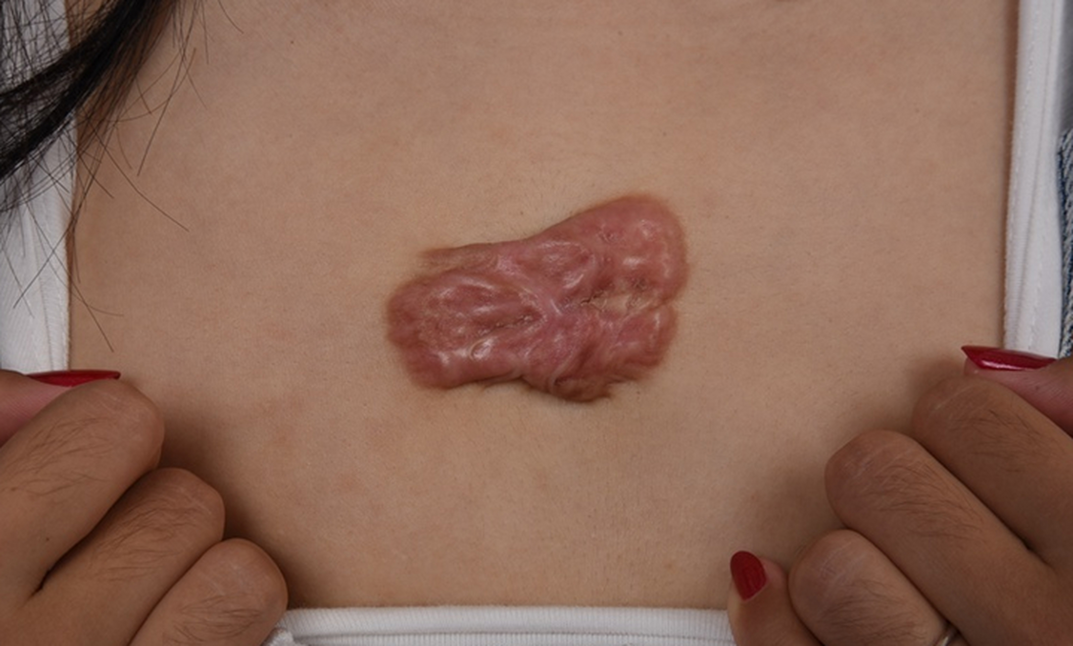 曾接诊过一位疤痕疙瘩患者,多年前胸前长了一个小疙瘩,一开始以为是痘