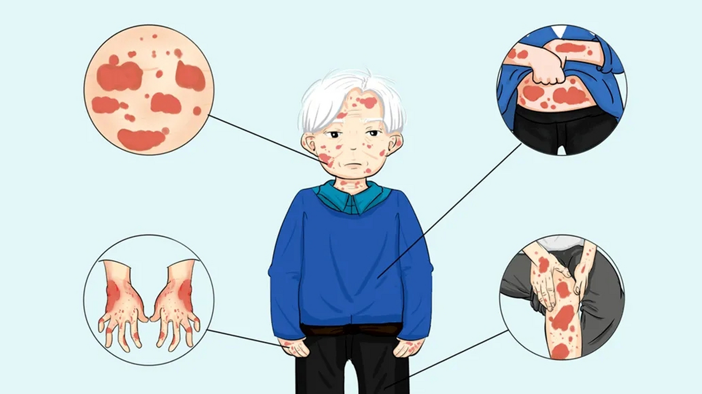 鳞屑掉落是银屑病在发病的症状表现之一,出现这一脱屑的现象,患者不