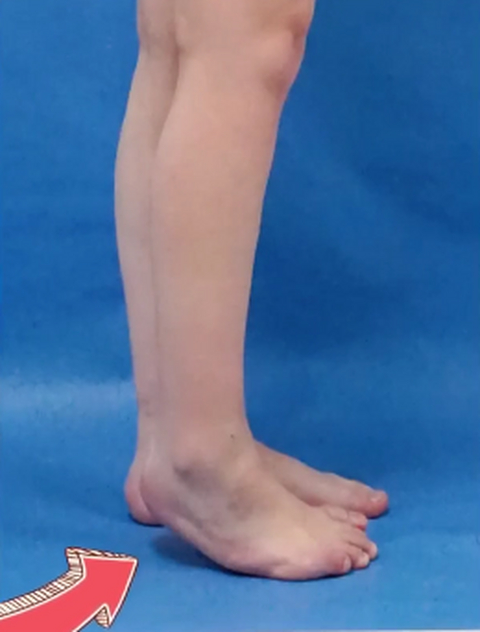 这是一位【马蹄内翻足】的患者,脚跟不着地是马蹄足的典型特征.