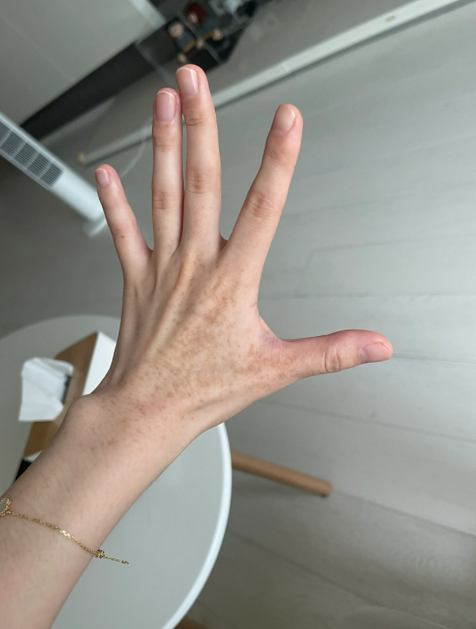 在解决手上晒斑怎么去除掉的问题上,我积累了一些心得,分享给大家.