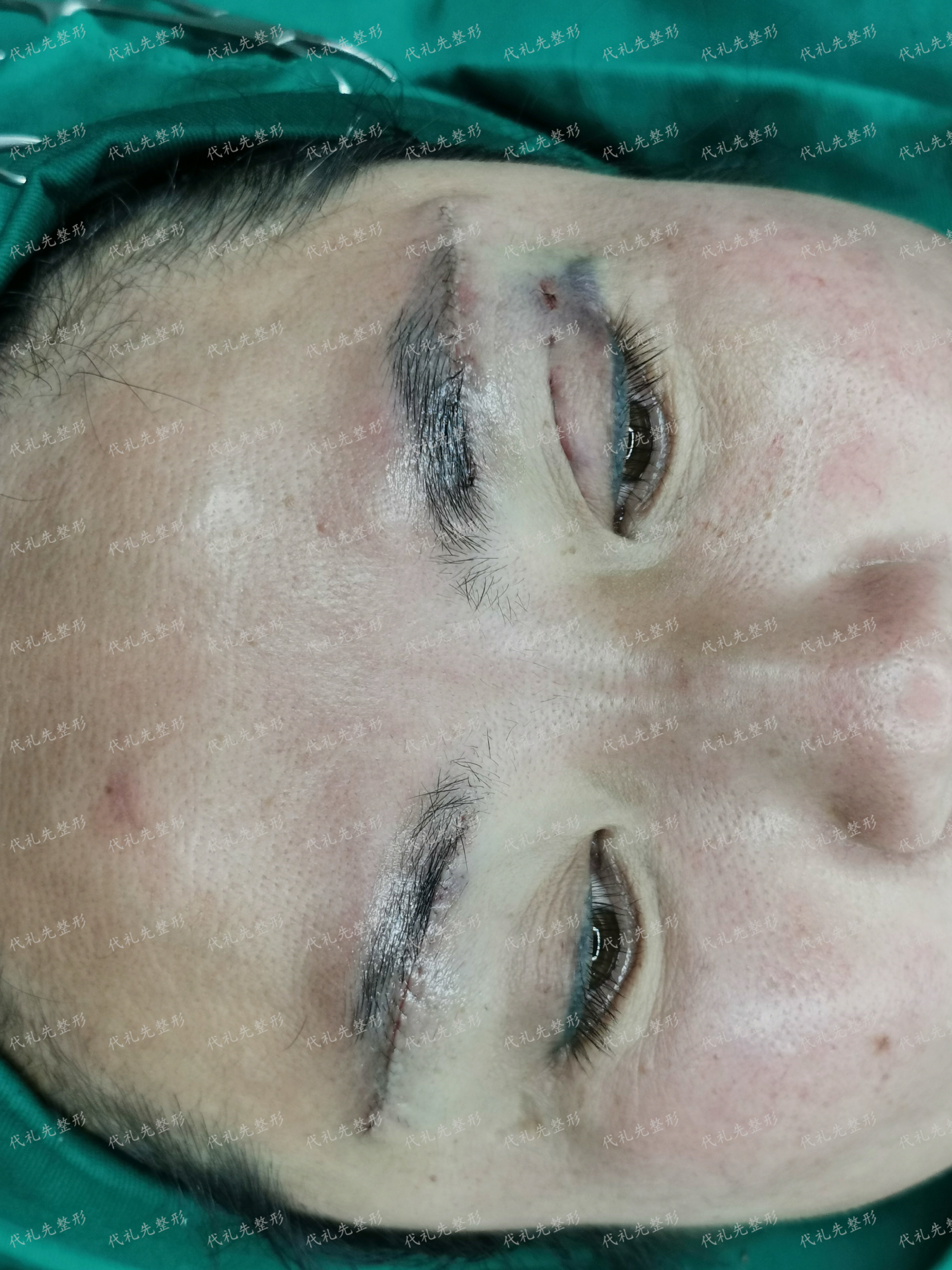 和大家说一下提眉手术的三大优势?