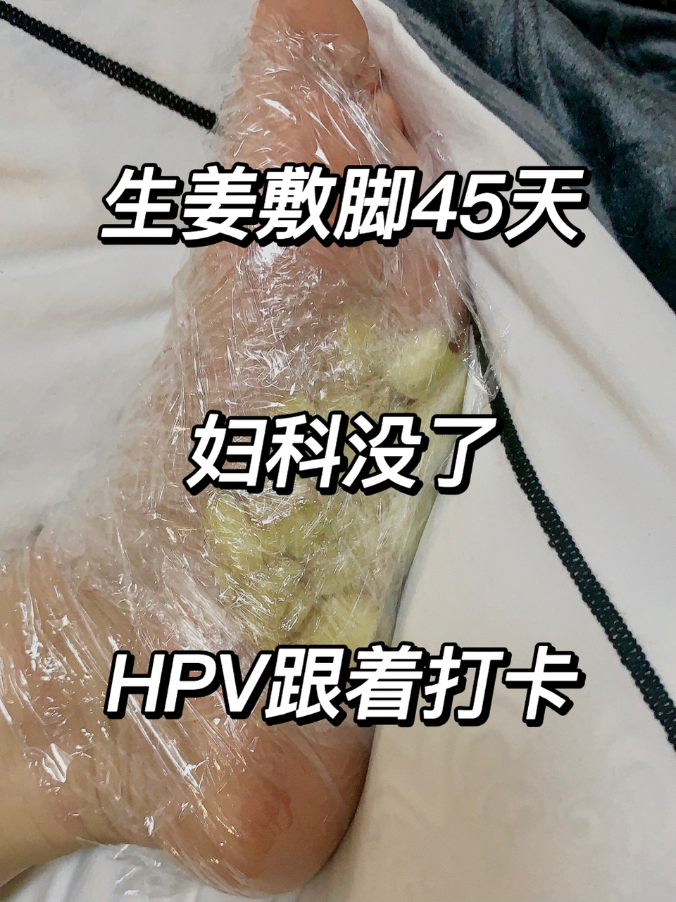 生姜敷脚45天,妇科没了,hpv跟着打卡 炎症反复,hpv感染难以转阴,注意