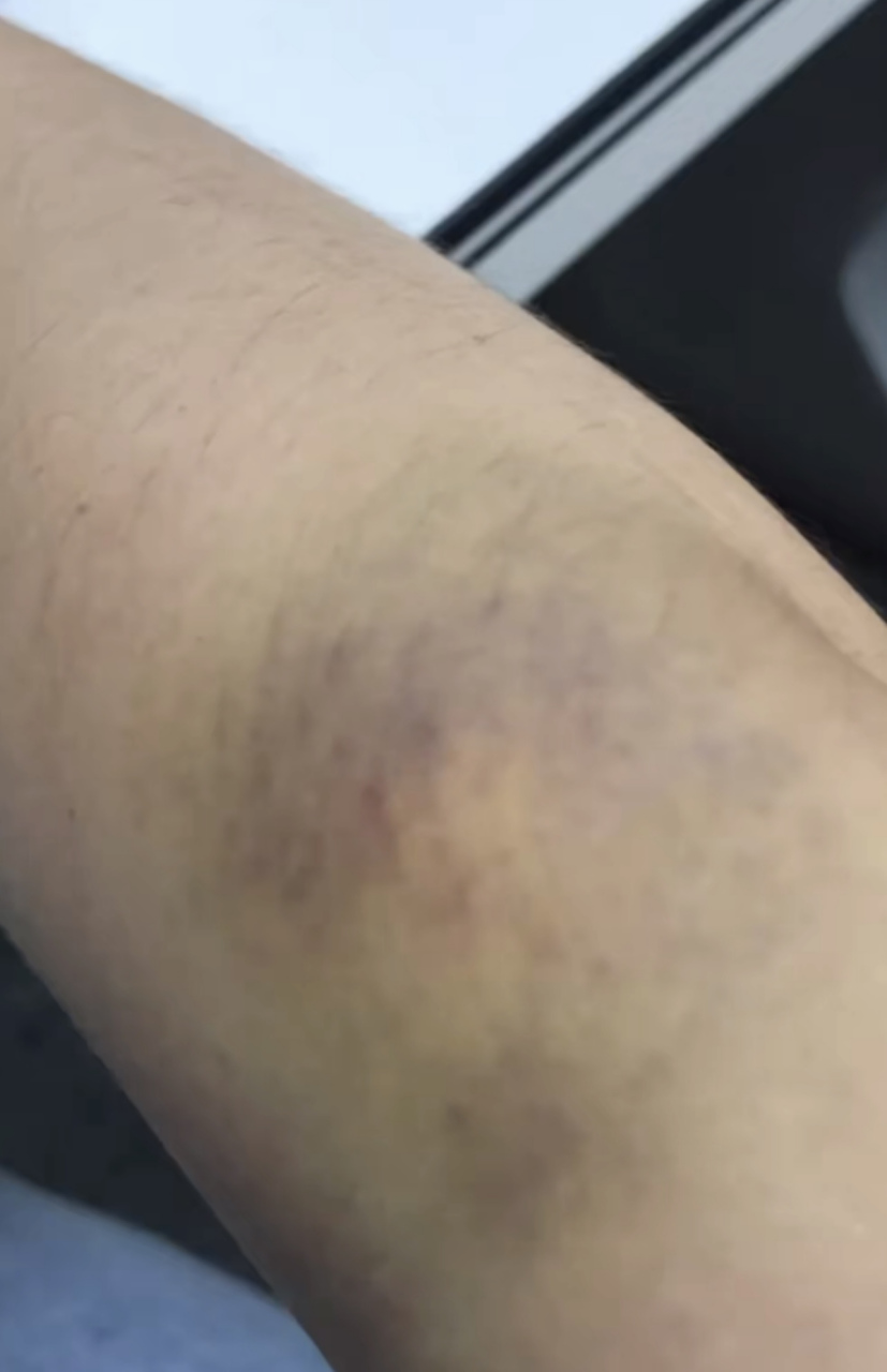 很多血小板减少的患者,四肢出血点淤斑乏力心慌,就算吃了激素,现在也