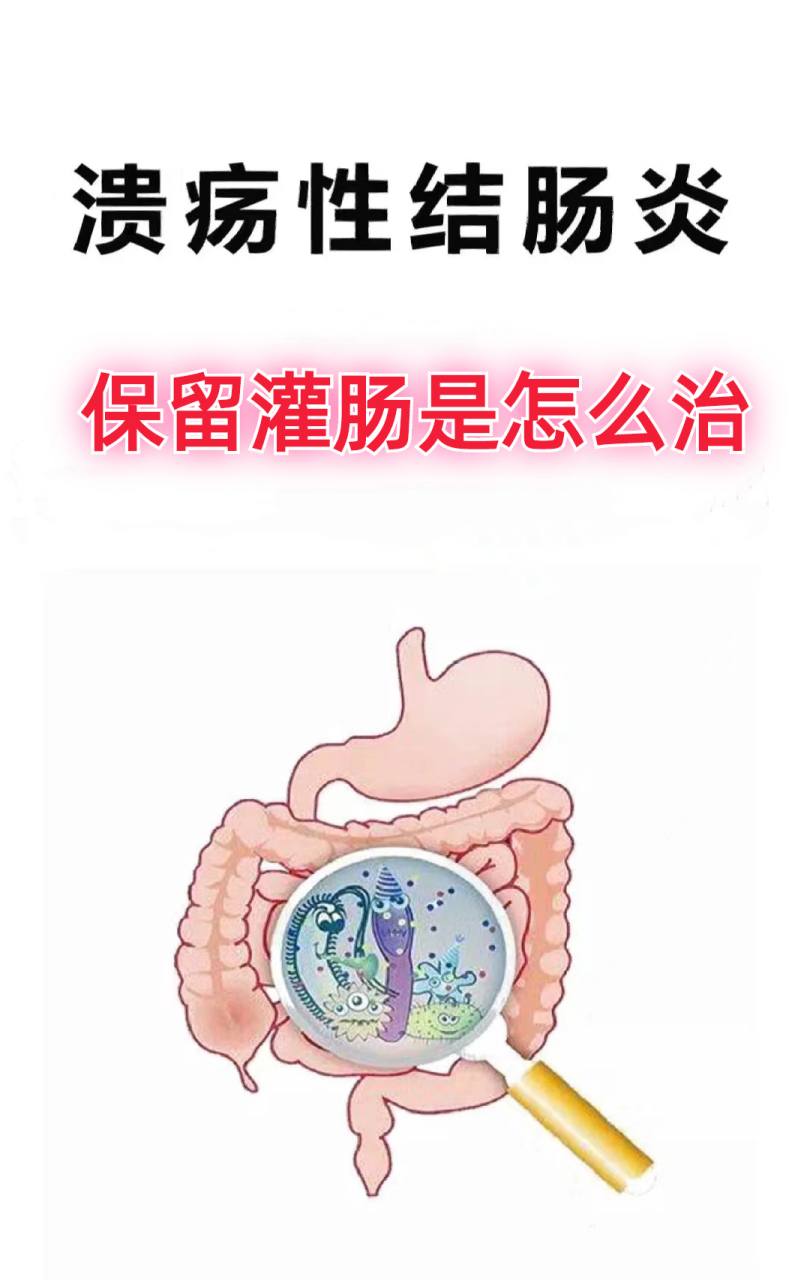 治疗溃疡性结肠炎的保留灌肠,是需要将药物保留到体内,通过注射器和导