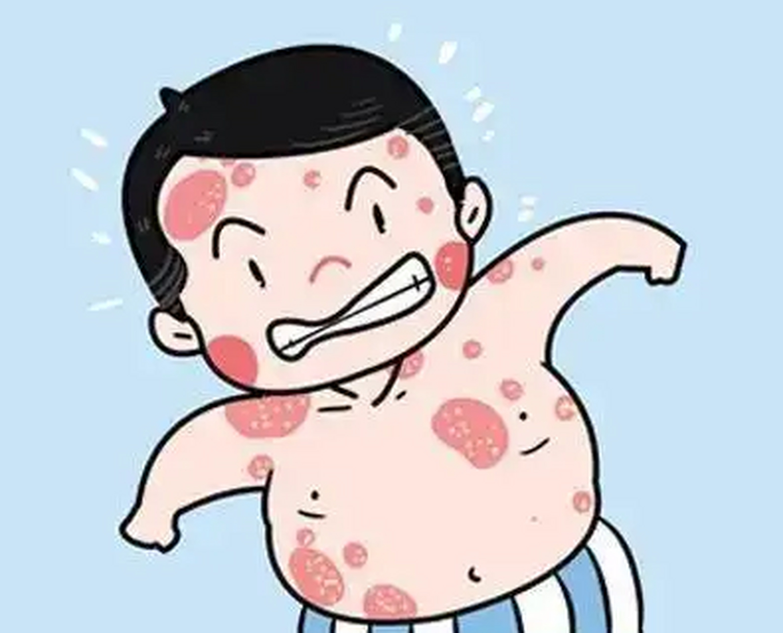银屑病是一种比较复杂的皮肤病,病因尚不明确,但临