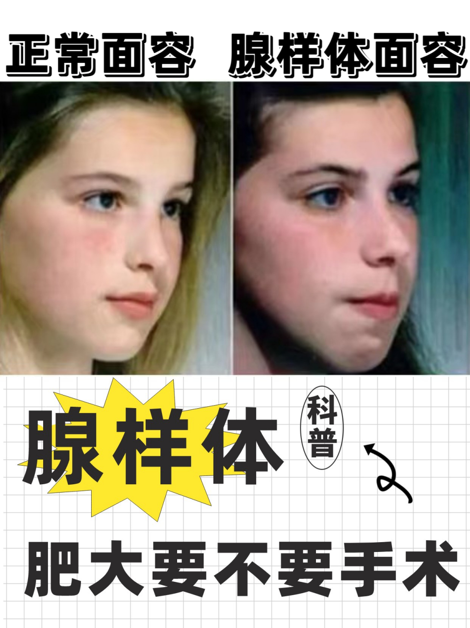 孩子的腺样体6到7岁发育到最大,10岁以后开始逐渐萎缩,成人后基本消失