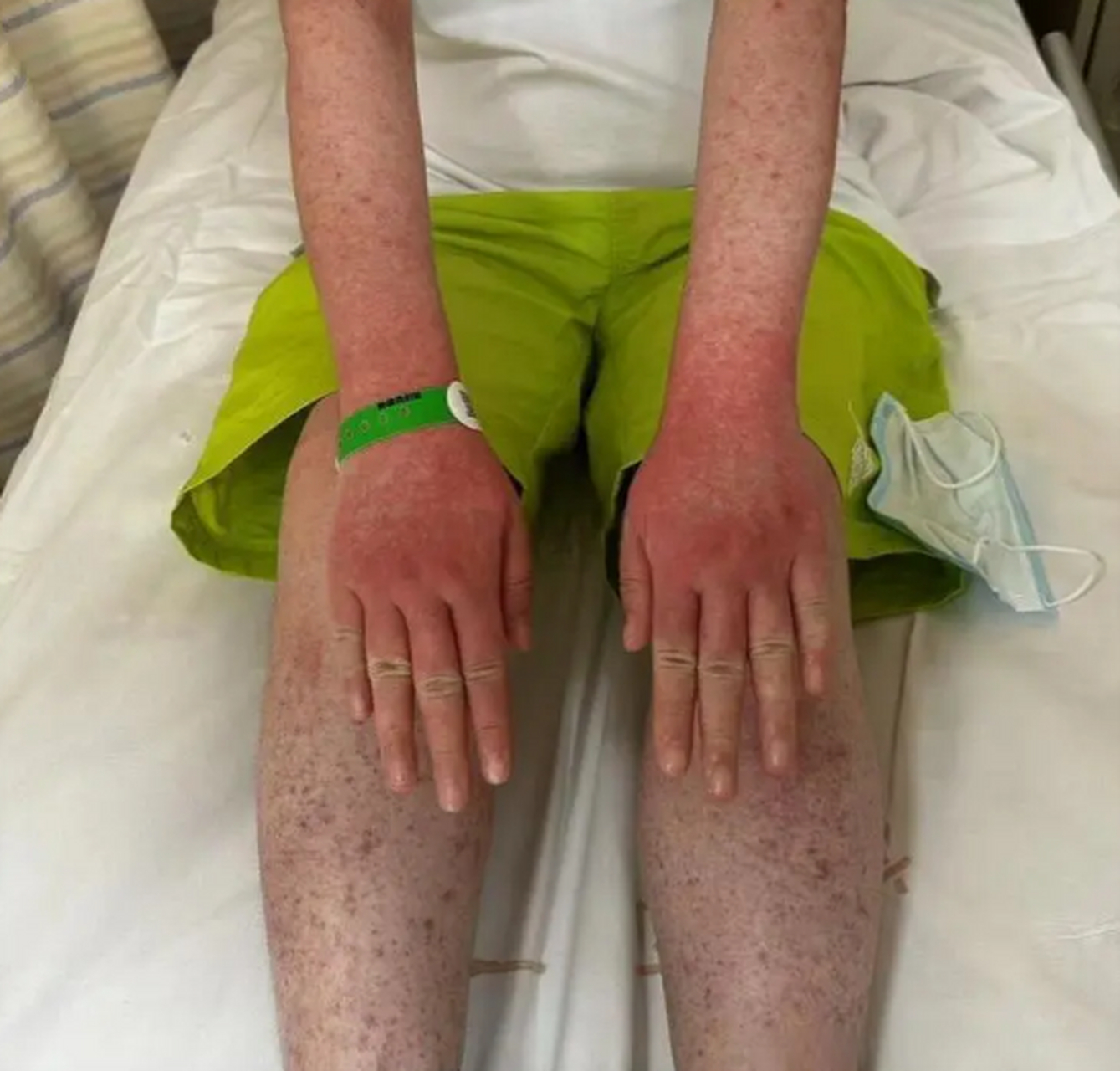 杭州女子养仓鼠脸烂成火龙果# 近日,杭州一女子因为全身布满出血性