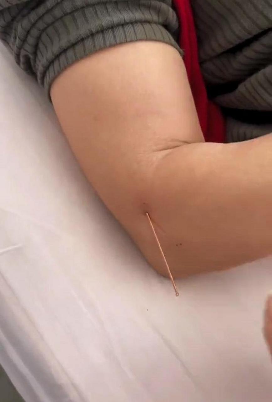 没有扎过银针,不知道这样疼不疼呢? #趣图搞笑