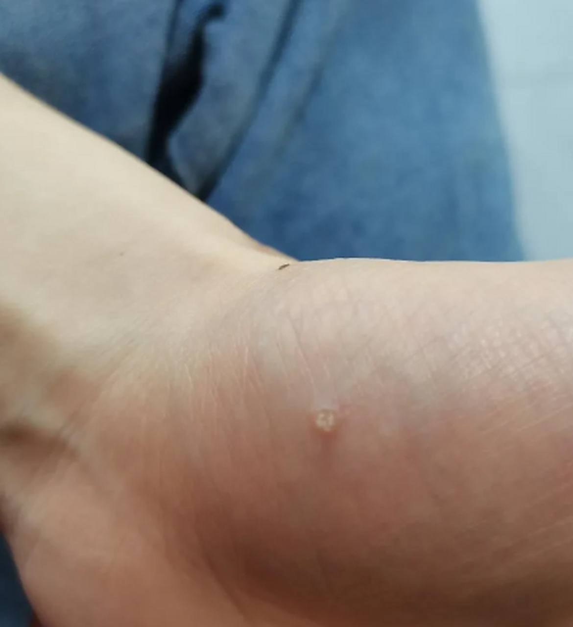 脚上长了一个硬节子,又厚又痛,    这叫跖疣,因为质地比较深,一般的